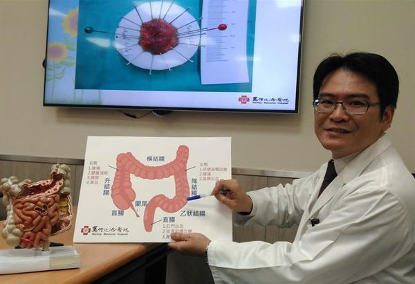 大腸瘜肉癌病變機率高 早期大腸癌治療有利器說明圖片