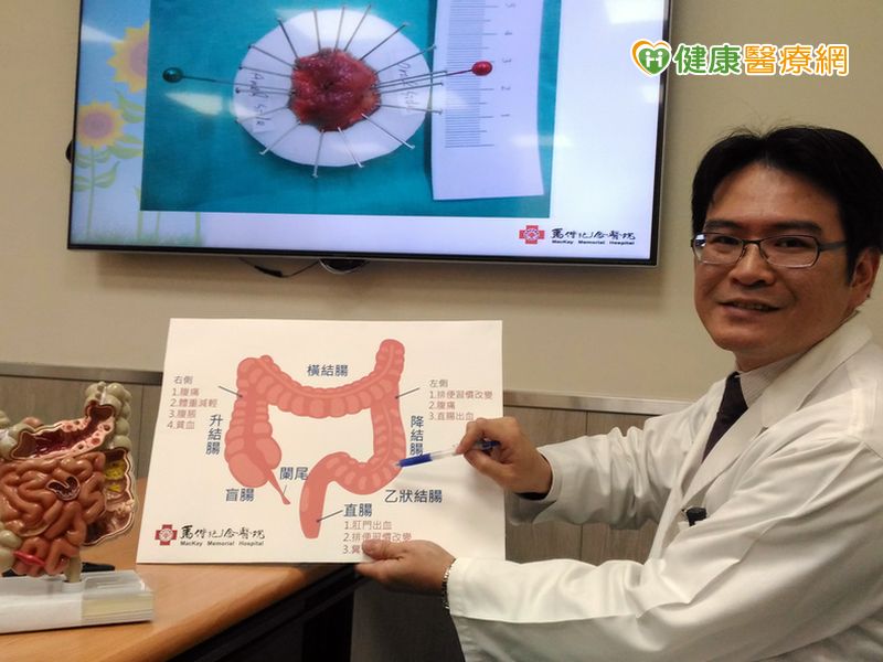 大腸瘜肉癌病變機率高 早期大腸癌治療有利器說明圖片