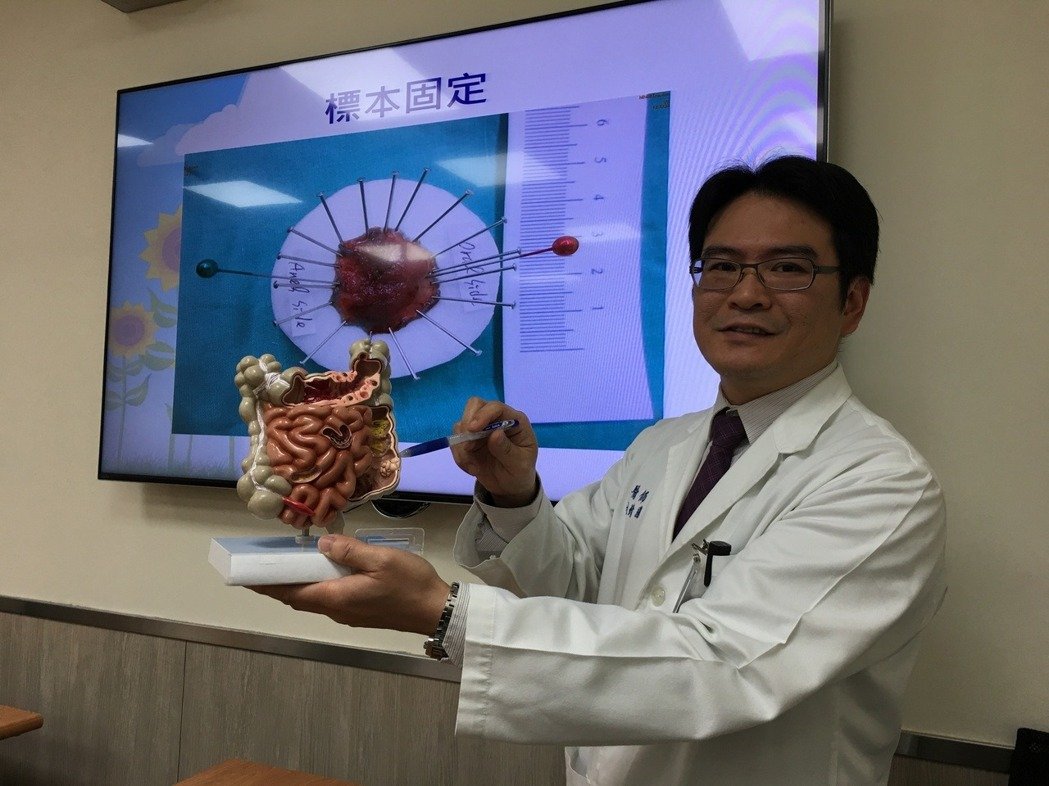 大腸瘜肉癌病變機率高 早期大腸癌治療有利器說明圖片