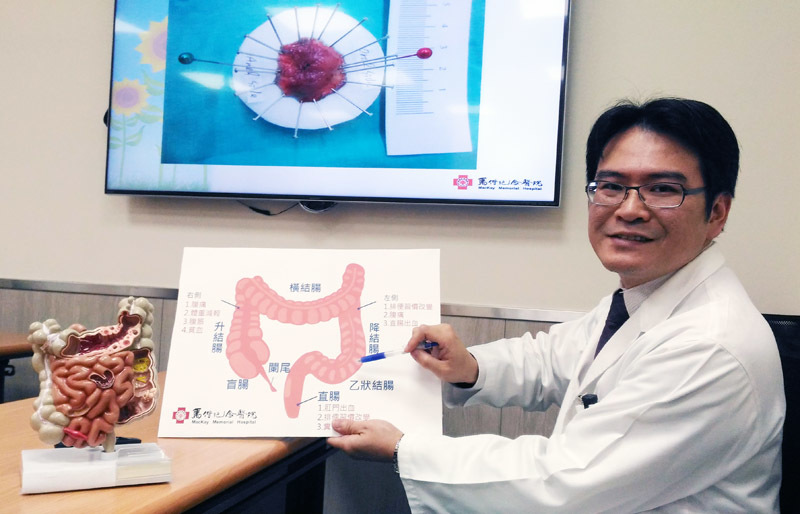 大腸瘜肉癌病變機率高 早期大腸癌治療有利器說明圖片