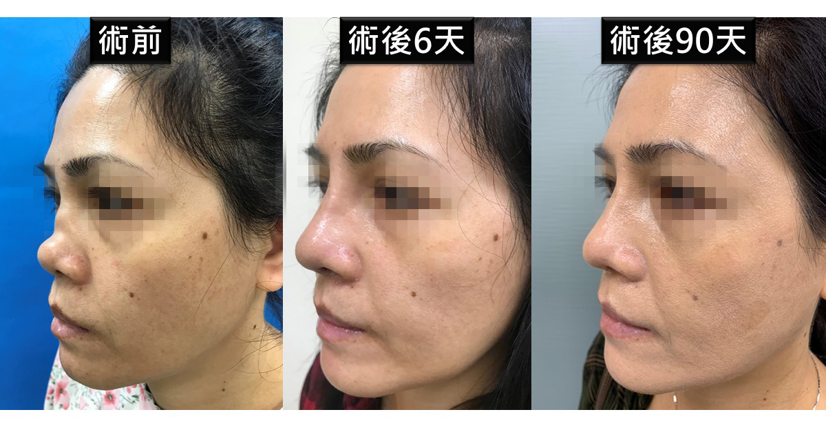 細菌侵蝕導致鼻型毀壞 馬偕醫以自體肋軟骨重建美鼻說明圖片