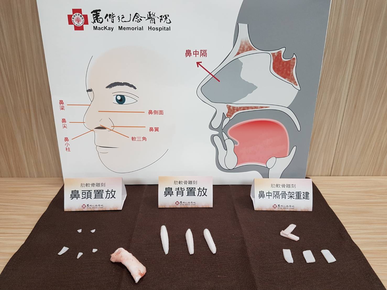 細菌侵蝕導致鼻型毀壞 馬偕醫以自體肋軟骨重建美鼻說明圖片