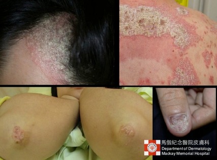 psoriasis-imp