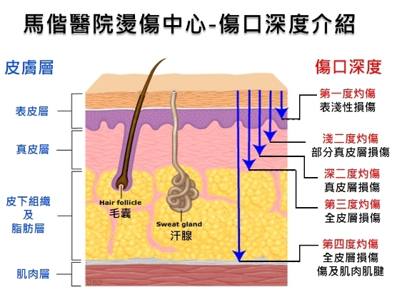 傷口深度說明